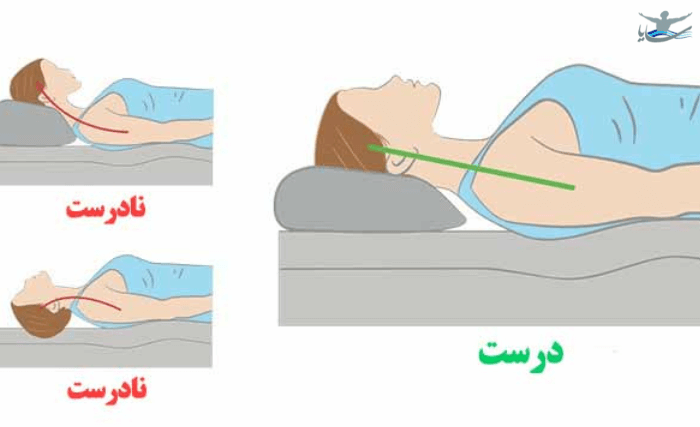 تاثیر نحوه خوابیدن در درمان آرتروز گردن