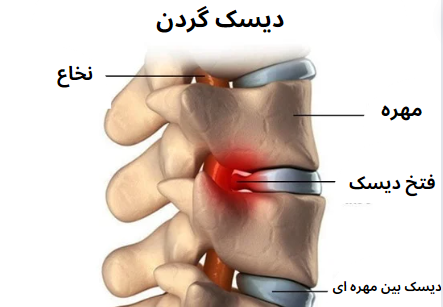 دیسک گردن