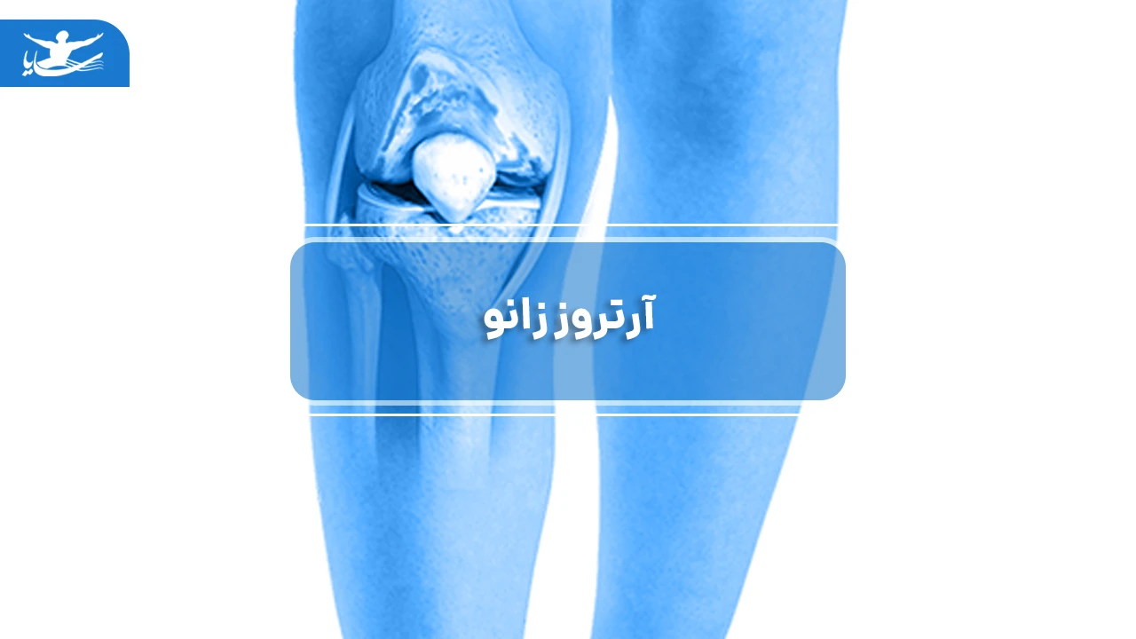 آرتروز زانو