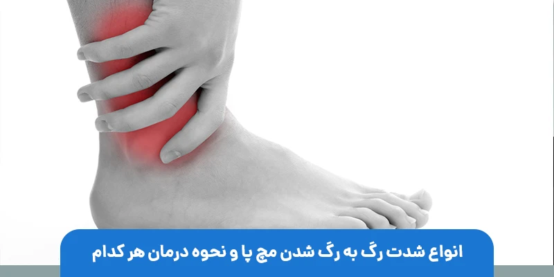 انواع شدت رگ به رگ شدن مچ پا و نحوه درمان هر کدام