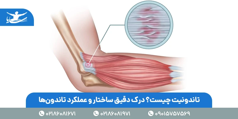 تاندونیت چیست؟