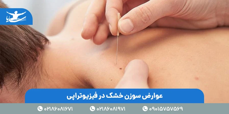 عوارض سوزن خشک در فیزیوتراپی