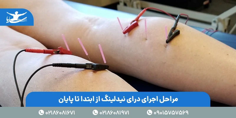 مراحل اجرای درای نیدلینگ از ابتدا تا پایان