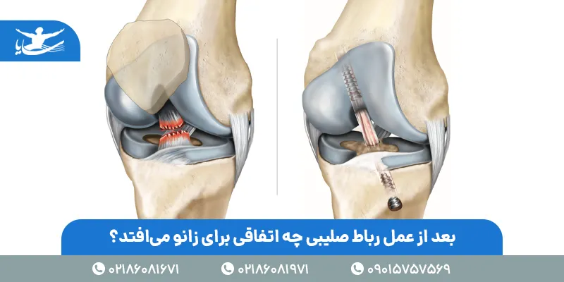 بعد از عمل رباط صلیبی چه اتفاقی برای زانو میافتد؟