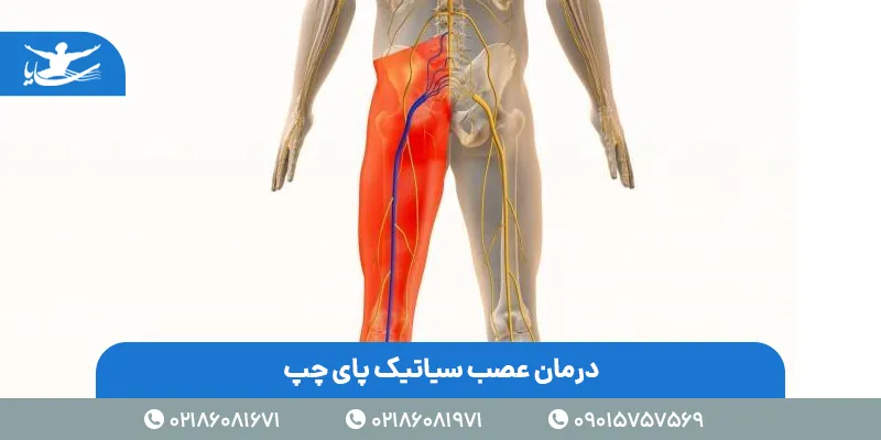 علت سیاتیک پای چپ