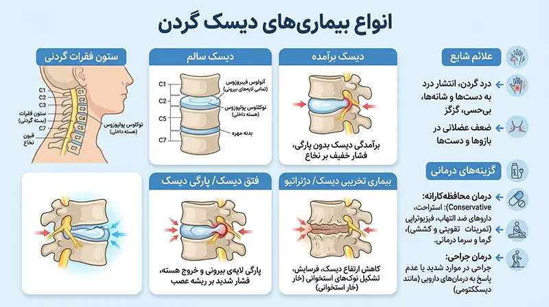 انواع دیسک گردن